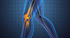 Knee Replacement Revision Washington DC and Northern Virginia